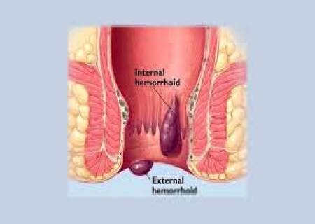 மூலநோய் குணமாக சாப்பிட வேண்டிய உணவுகள்