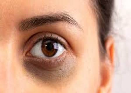 கண்களின் கருவளையத்தை நீக்க …