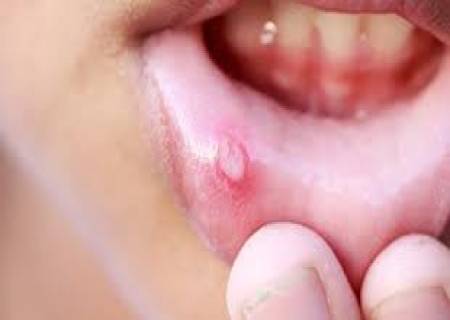வாய்ப்புண் அடிக்கடி வருவதால் உடல் கொடுக்கும் எச்சரிக்கை.
