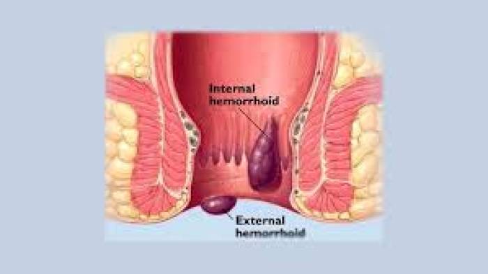 மூலநோய் குணமாக சாப்பிட வேண்டிய உணவுகள்