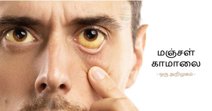 மஞ்சள் காமாலை.